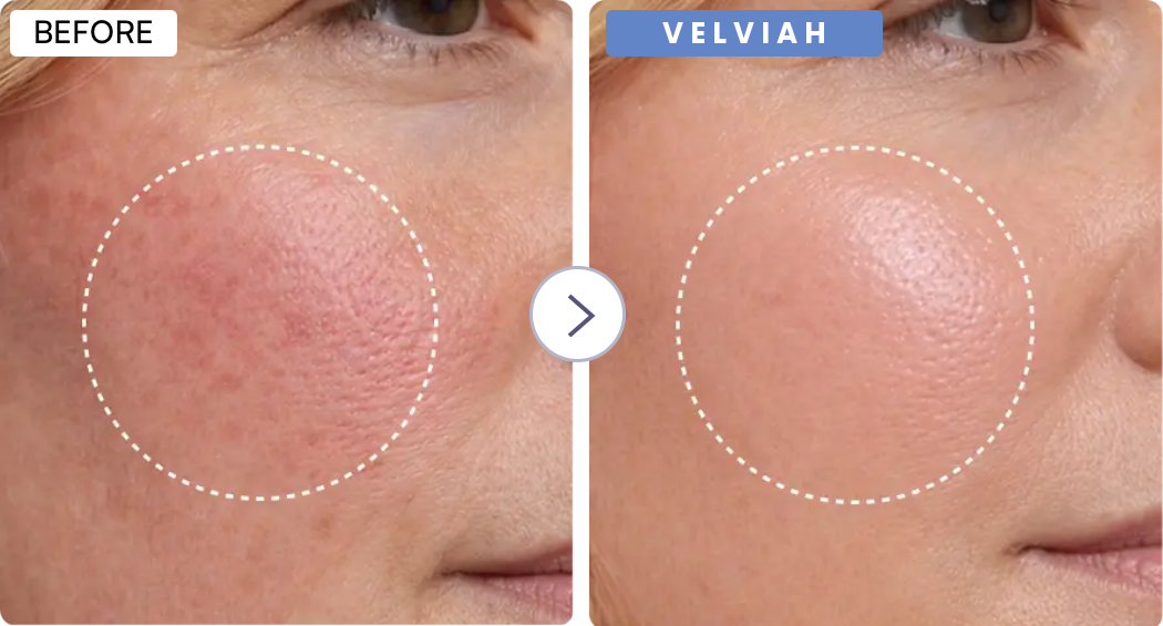 Velviah  ProGlow antiaging  Red Light Therapy  Mask