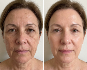 Wireless Anti aging light therapy