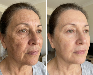 Wireless Anti aging light therapy